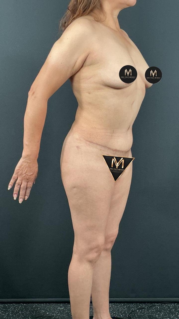 Abdominoplastia: depois