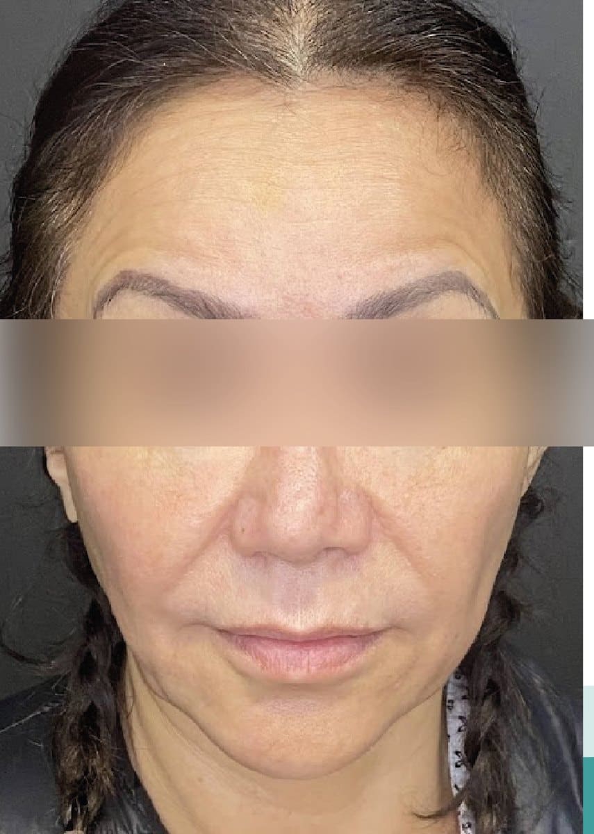 Lifting facial: antes