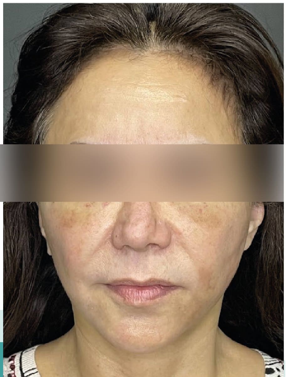 Lifting facial: después