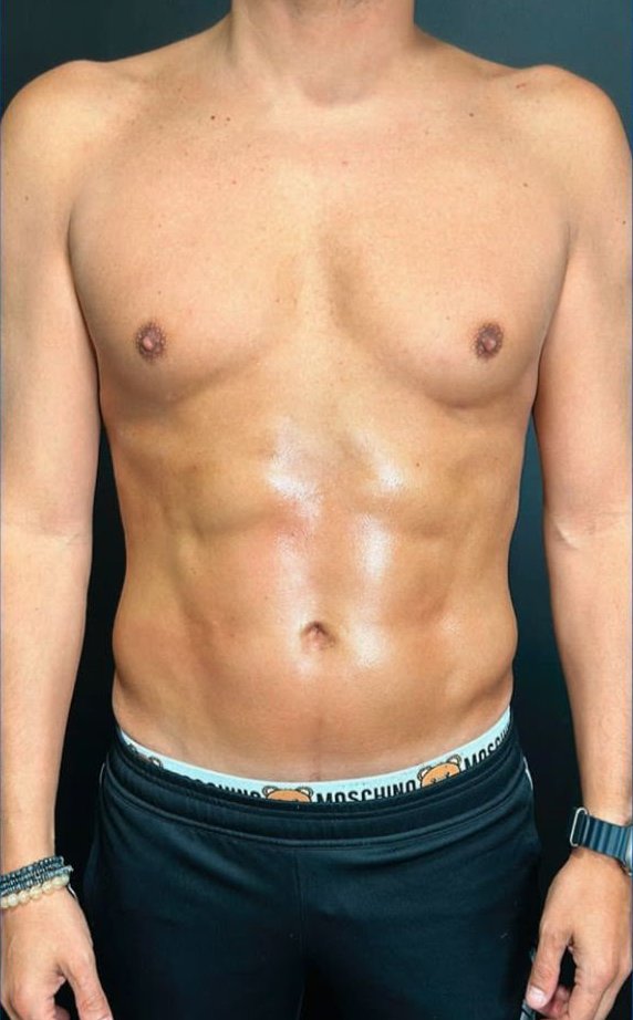 Lipo HD masculina · 3 meses: depois