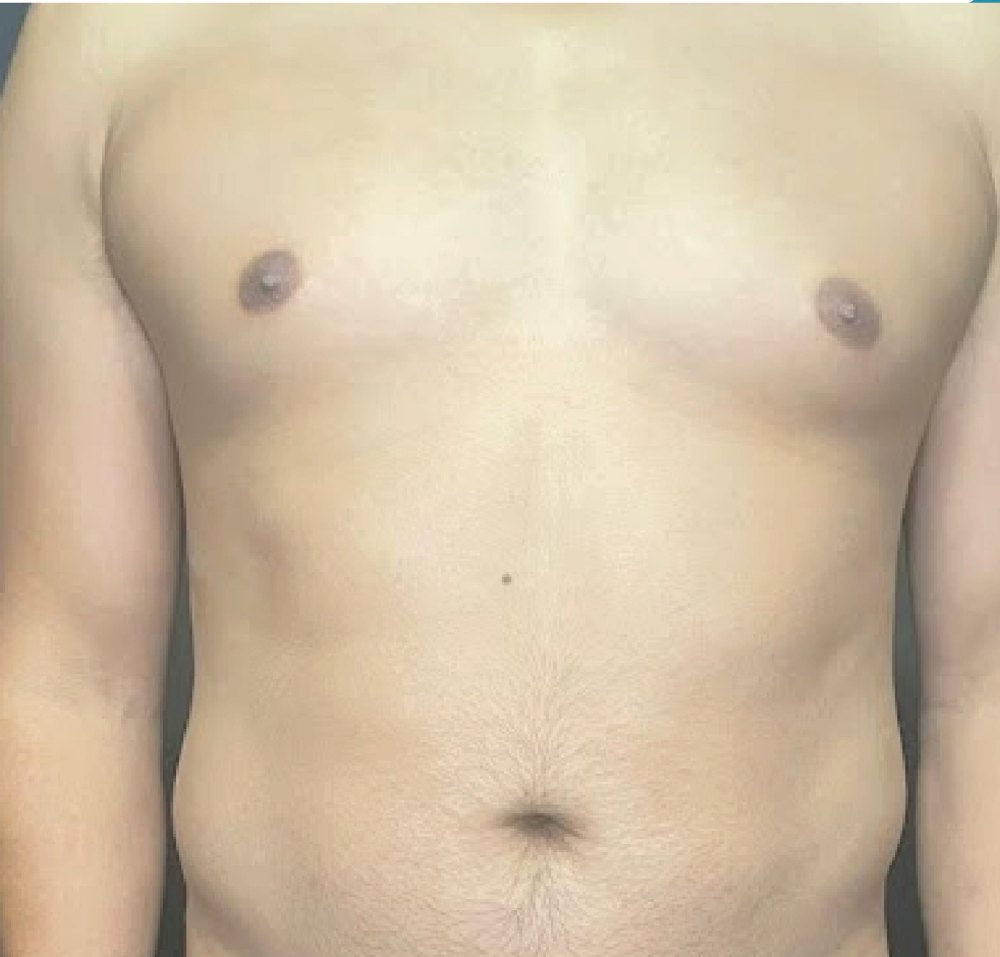 LipoVaser HD en hombre: antes
