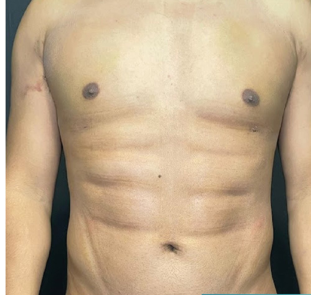 LipoVaser HD en hombre: después