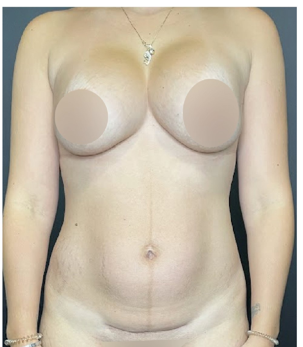 Abdominoplastia + mastopexia: antes