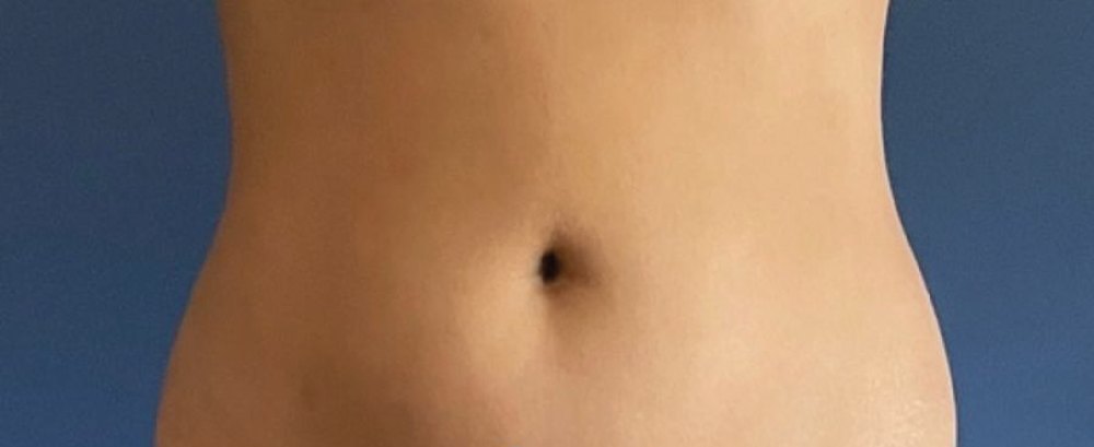 LipoVaser Soft Definition + Renuvion: antes